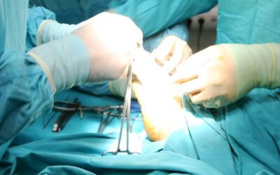 Cirugía Mínimamente Invasiva del Pie: Beneficios y Recuperación